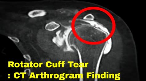 supraspinatus tear tests|full thickness tear supraspinatus.